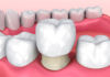 Kişinev Diş Kliniği - Premium hizmetlerin avantajları
