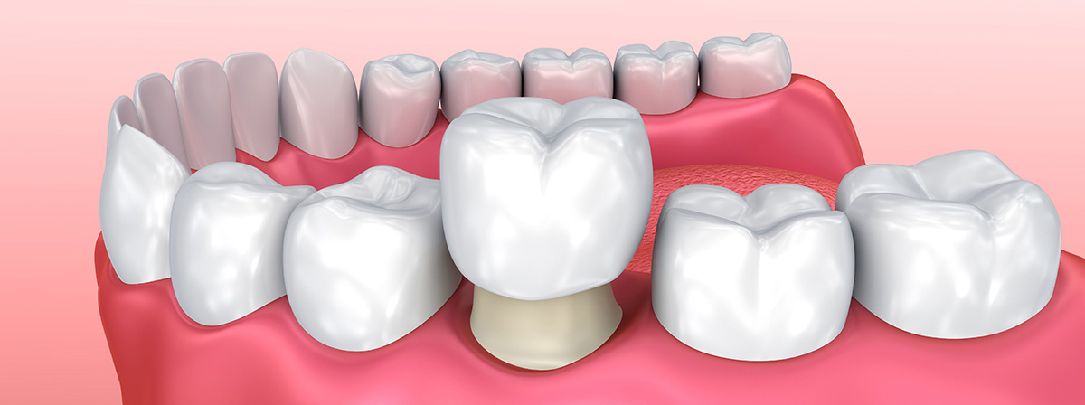 Технология зубного протезирования